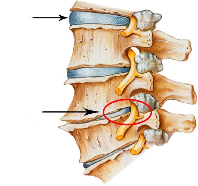 Ontwikkeling van schijf hernia