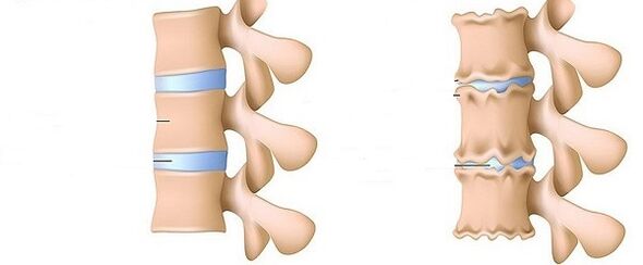 Gezonde wervelkolom en osteochondrose