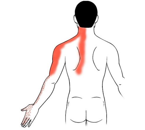cervicale osteochondrose als oorzaak van pijn in de gewrichten van de vingers