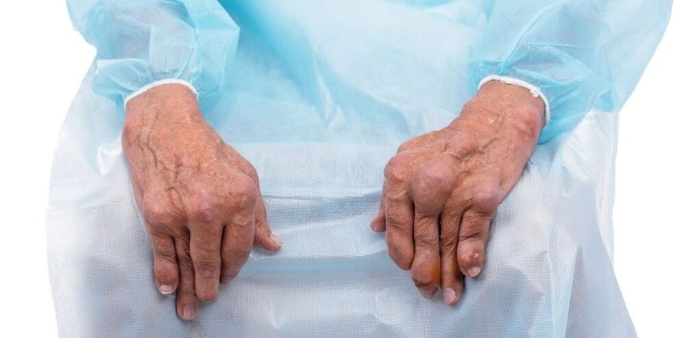 Infectieuze artritis is een ziekte met constante pijn en veranderingen in de gewrichten van de vingers.