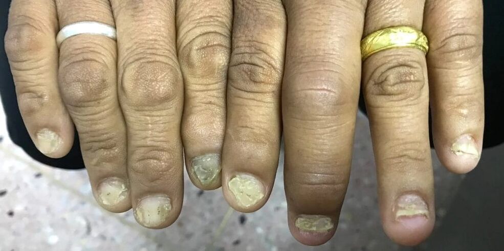 Zwelling van de vingers en vervorming van de nagelplaat kunnen wijzen op de ontwikkeling van artritis psoriatica