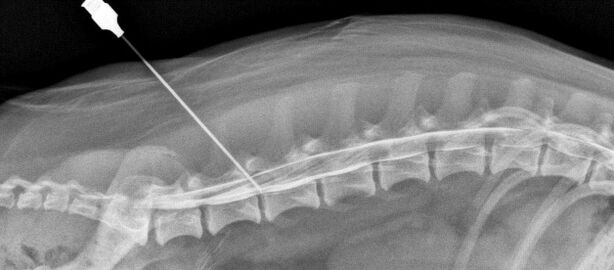 blokkade van de wervelkolom met osteochondrose